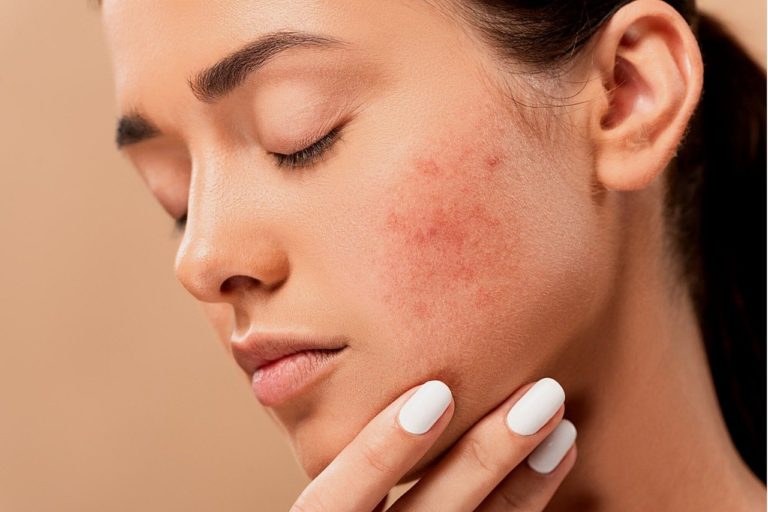 Herbal Acne Treatment – Alternative Care for Your Skin